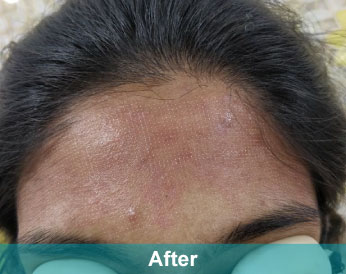 After treatment at Akshara Clinic, Mota Varachha Surat