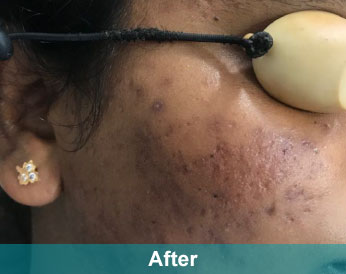 After treatment at Akshara Clinic, Mota Varachha Surat