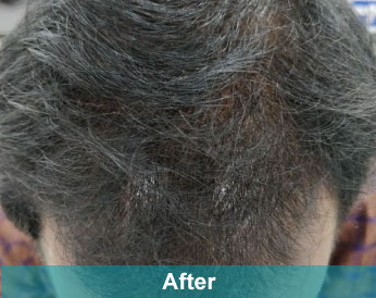 After treatment at Akshara Clinic, Mota Varachha Surat