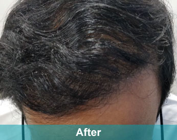 After treatment at Akshara Clinic, Mota Varachha Surat
