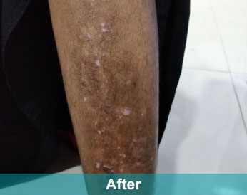 After treatment at Akshara Clinic, Mota Varachha Surat