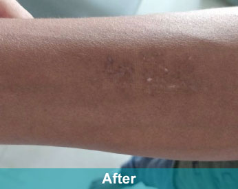 After treatment at Akshara Clinic, Mota Varachha Surat