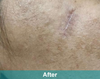 After treatment at Akshara Clinic, Mota Varachha Surat