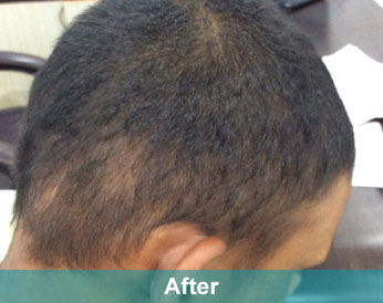 After treatment at Akshara Clinic, Mota Varachha Surat