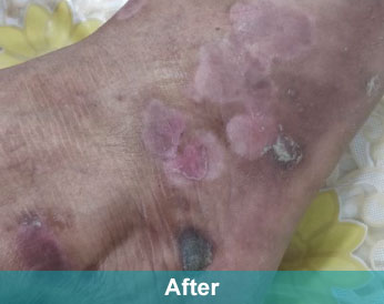 After treatment at Akshara Clinic, Mota Varachha Surat