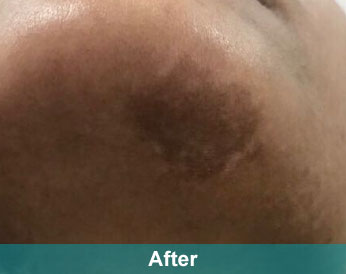 After treatment at Akshara Clinic, Mota Varachha Surat